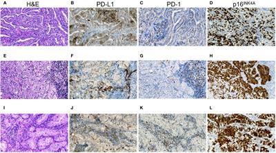 Characteristics and immune checkpoint status of radioiodine-refractory recurrent papillary thyroid carcinomas from Ukrainian Chornobyl Tissue Bank donors